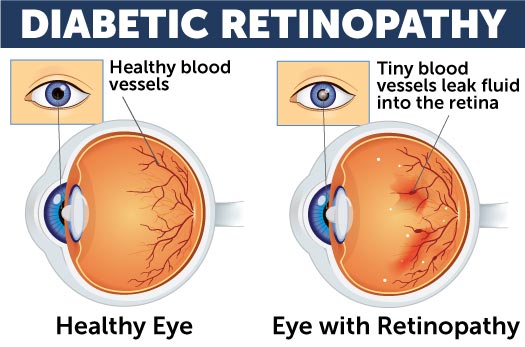 Retina_DiabeticRetinopathyDiagram